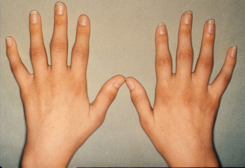 手指肿痛僵硬,有结节,预示着哪些疾病?医生详述常见的