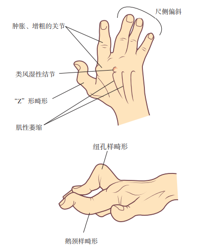 手指肿痛僵硬,有结节,预示着哪些疾病?医生详述常见的