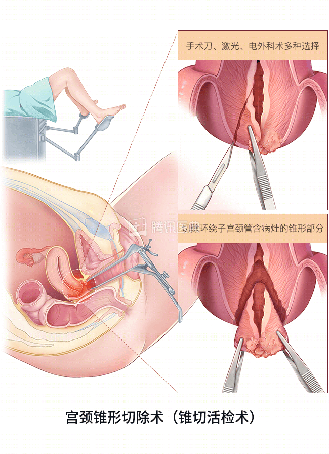 我在他乡挺好的:纪南嘉得的宫颈癌,现实中真的能治好吗?
