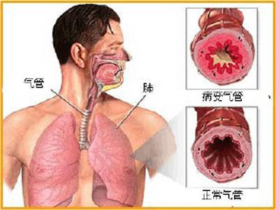 支气管哮喘发作的原因及日常注意事项