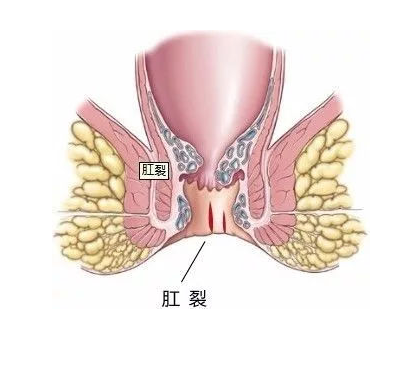 总说肛裂不可小觑,那如何治疗才有效果呢?