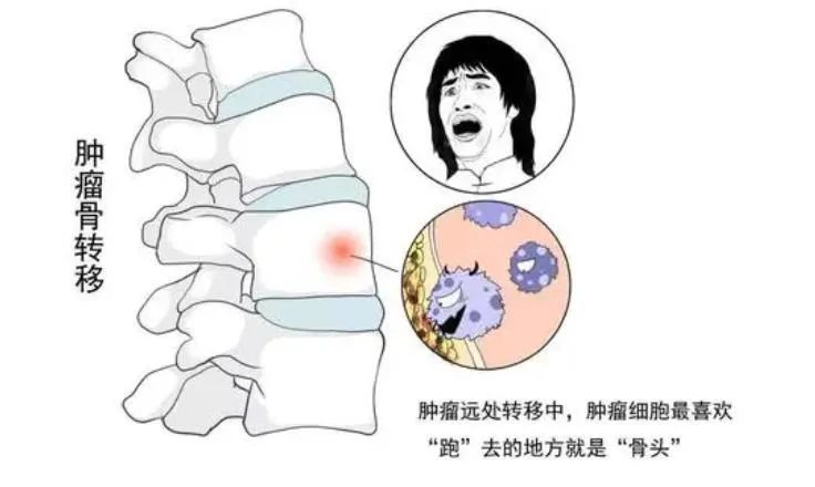 癌症骨转移前,身体会发出这些求救信号!尤其是"高危关键期"!