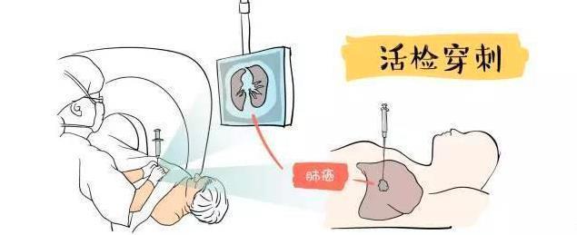 发现了肺结节,要确诊肺癌,是做穿刺活检还是pet-ct?
