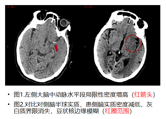 突发肢体活动不灵怀疑急性脑梗,应该做什么检查?