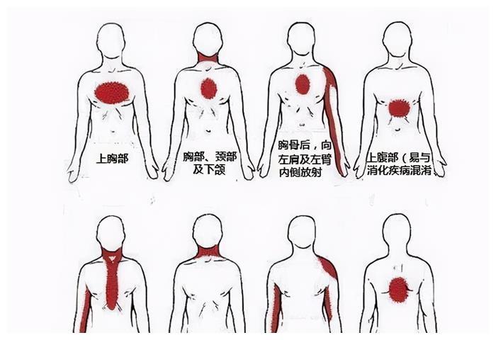 59岁男子多次心梗前兆未重视,5点心脏停跳!科普:心梗前兆!