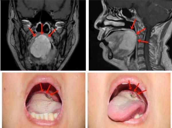 做核酸检测意外查出舌根癌究竟是怎么一回事图