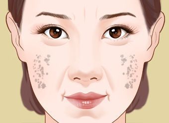 肝郁气滞型黄褐斑怎么治?就用经方逍遥散