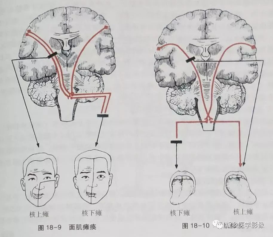 传导路: Ⅰ级-上运动神经元  (核上瘫),Ⅱ级-下运动神经元  (核下瘫)