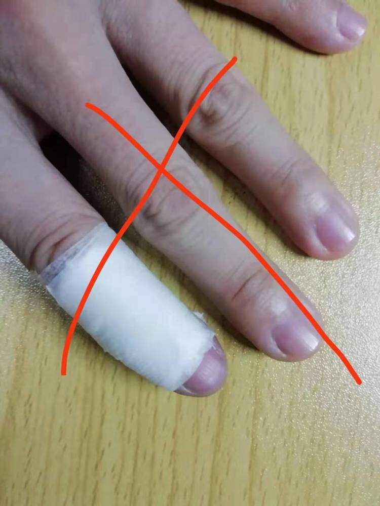 3岁女童手指受伤被奶奶错误包扎,导致截肢!这个正确包扎赶紧学一下!