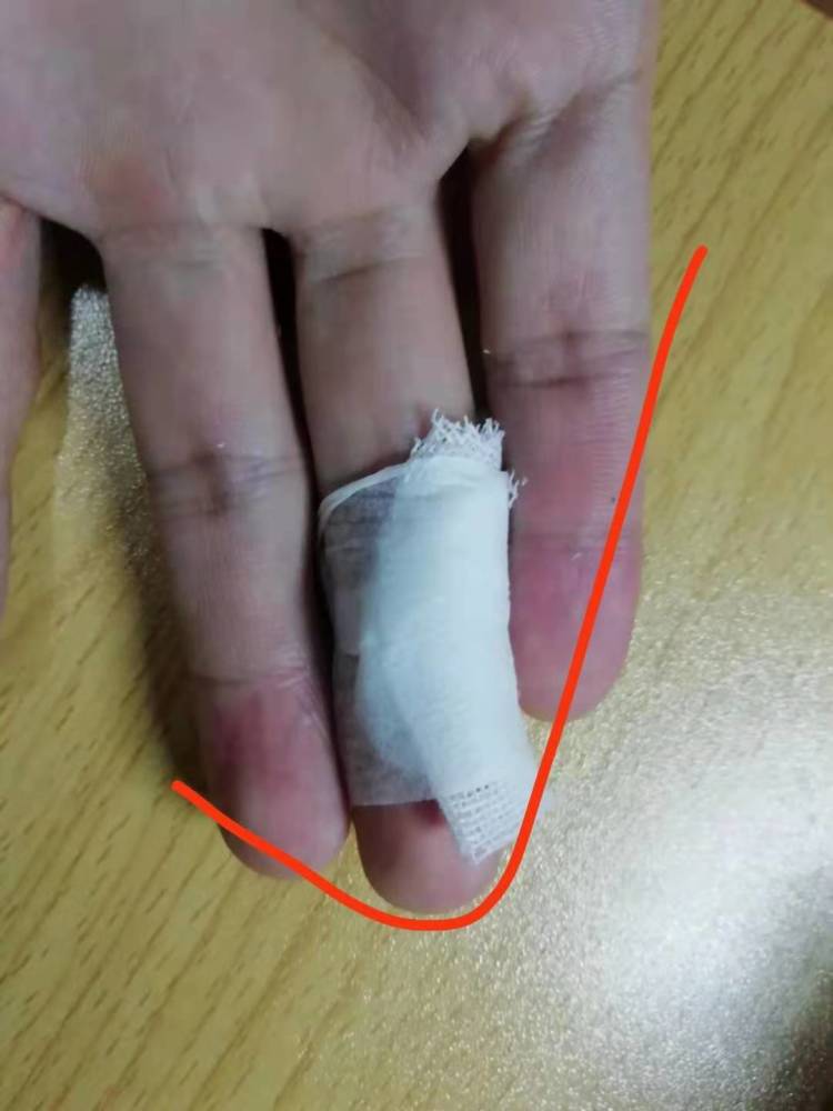 3岁女童手指受伤被奶奶错误包扎,导致截肢!这个正确包扎赶紧学一下!