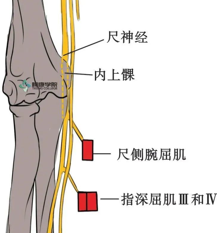 肘尺管struthers弓胸小肌和肩胛下肌之间斜角肌间隙常见卡压部位此外