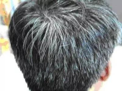 为什么白头发越长越多医生提醒并非老了或与这4个因素有关