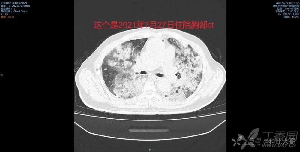 73 岁患者咳白色泡沫痰,肺部感染找不到致病菌,用药也无好转,问题竟在