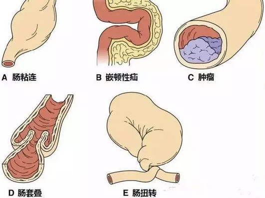 引起肠梗阻的原因可分为机械性肠梗阻和非机械性肠梗阻.