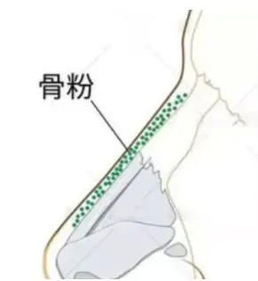 李方奇隆鼻用的骨粉可以不取出来吗会不会感染