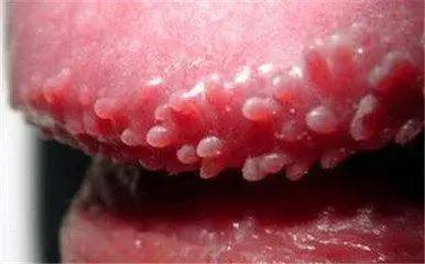 3岁女孩感染hpv,查出原因妈妈后悔不已!这疫苗,真别省!