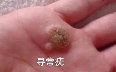 皮肤上长这种"小疙瘩",可能和hpv感染有关