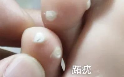 皮肤上长这种"小疙瘩",可能和hpv感染有关