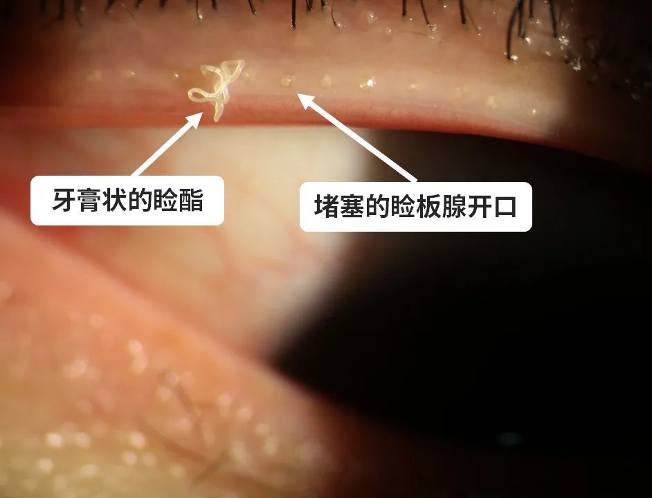 男子眼皮中竟挤出"牙膏"!他的习惯很多人都有