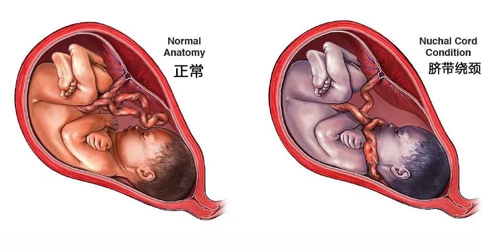 八个月宝宝胎死腹中!可怕的"脐带扭转",让医生都吓出一身冷汗!