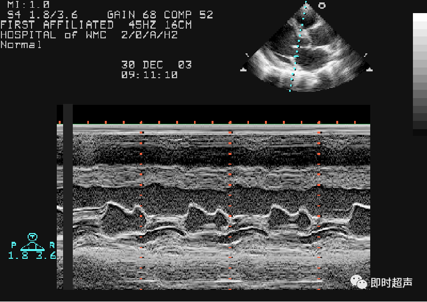 m型超声心动图二尖瓣波群左房血栓二尖瓣口面积二尖瓣水平短轴观切面