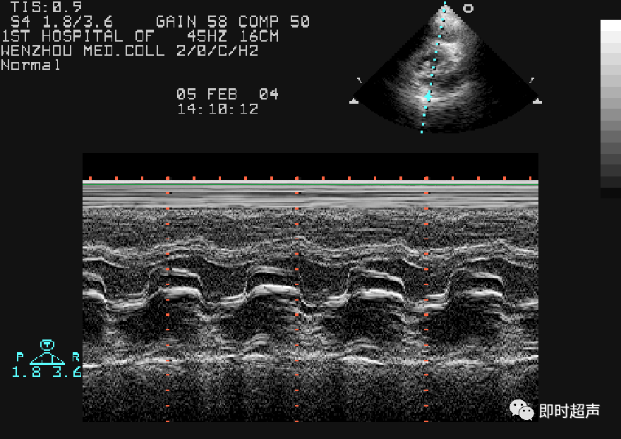 m型超声心动图二尖瓣波群左房血栓二尖瓣口面积二尖瓣水平短轴观切面