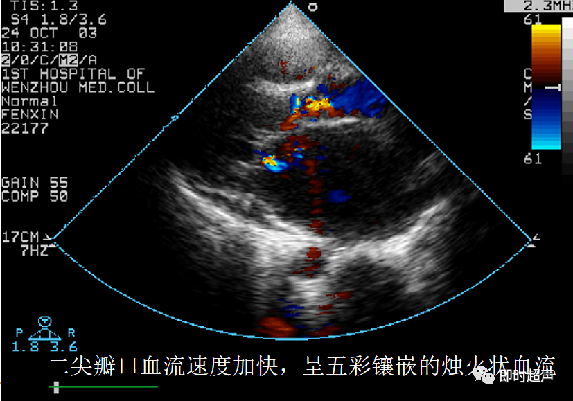 ef斜率正常 双峰存在前后瓣叶反向运动m型超声心动图二尖瓣波群左房
