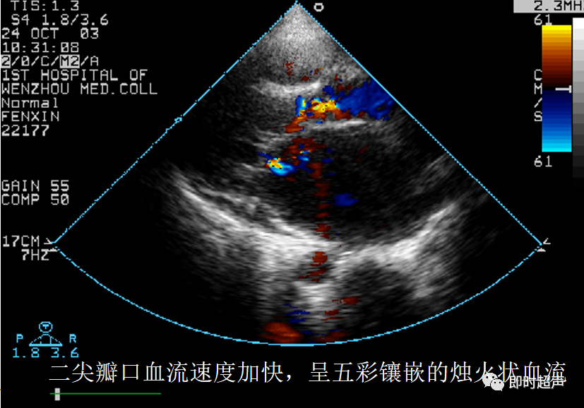 彩色多普勒血流显像前叶增厚 开放受限样前后瓣同向运动二尖瓣前 叶