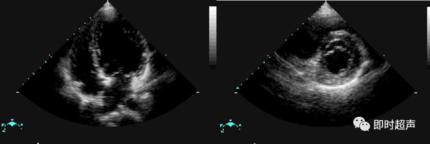 二尖瓣脱垂时可显示二尖瓣叶收缩期脱人左房 (后叶)