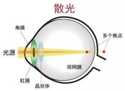 警惕丨孩子总是眯眼睛=近视?错,小心是散光!