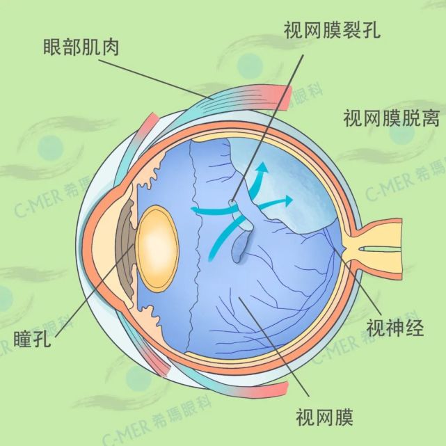 一男子拿筋膜枪按摩眼球,按到视网膜脱离!