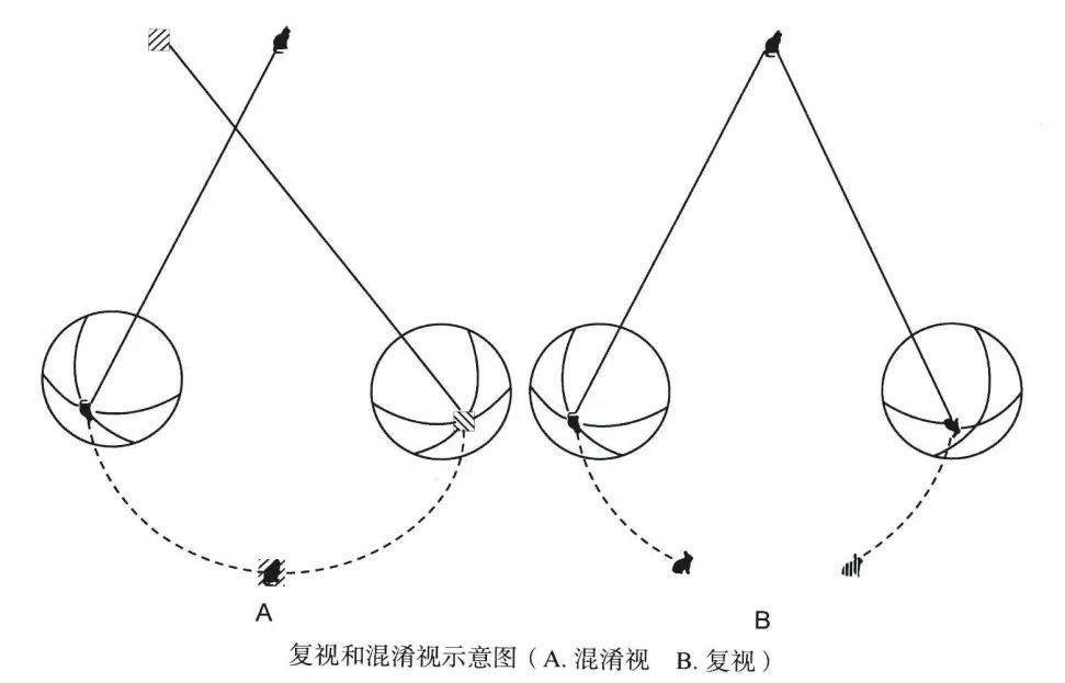 会出现混淆视(同时看到两个不同的物像)或复视(同时看到两个相同的物