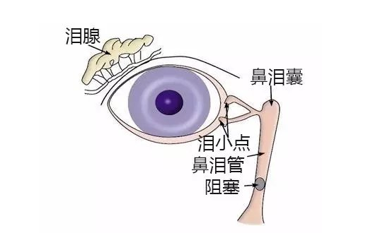 泪道|鼻泪管|新生儿|新生儿泪囊炎
