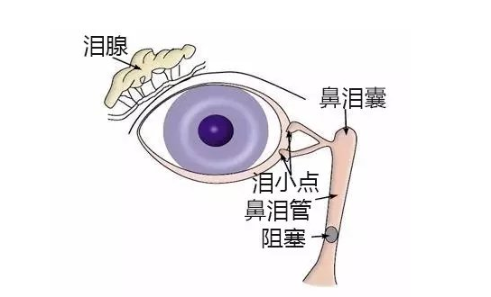 新生儿泪道堵塞无法手术的情况下怎么办