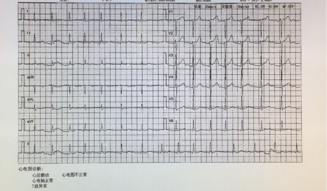 心电图