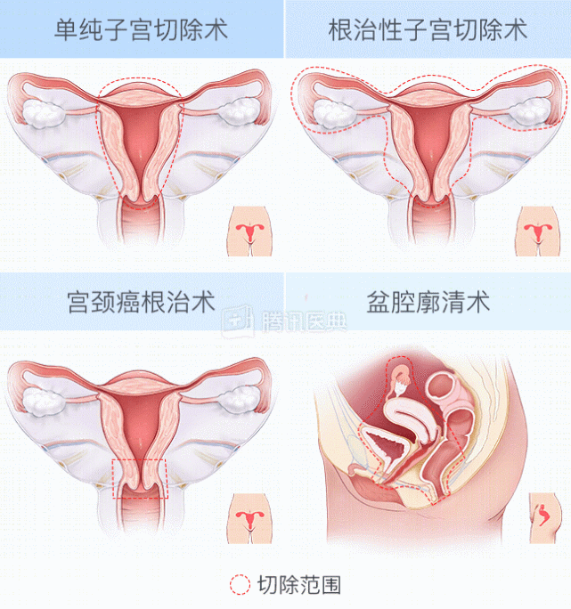 女人切除子宫后,会迅速变老吗?