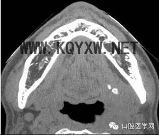 口腔病变x光片之涎石病(附疾病资料)