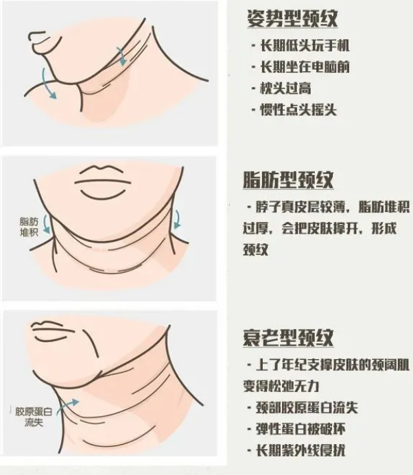 1,先天性颈部皮肤松弛或脂肪堆积.