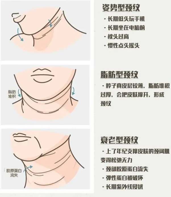 颈纹的形成原因及治疗方法