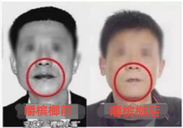 槟榔,公认的一级致癌物,被国外认定为毒品!