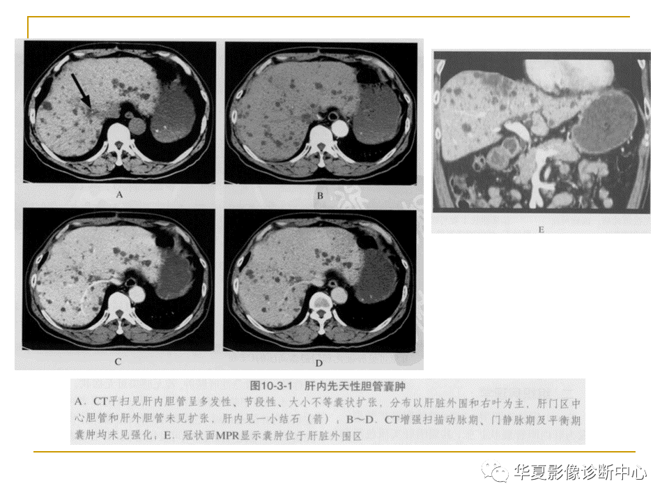 盆腔积液 (点击进入医看视频                    频)