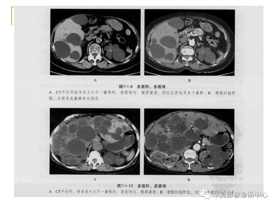 盆腔积液 (点击进入医看视频                    频)