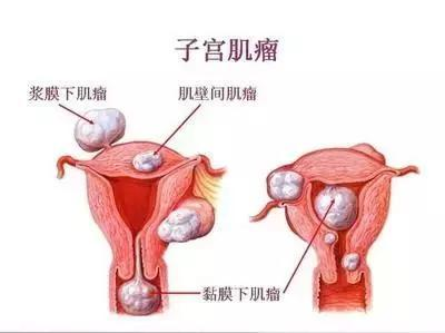 子宫肌瘤是怎么引起的（子宫肌瘤是怎么引起的原因）
