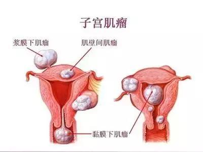 很少见于青春期女性患有子宫肌瘤,绝经后子宫肌瘤发生萎缩或者消退