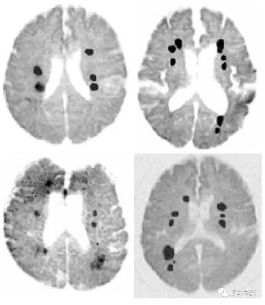 见下图贫血性脑梗死的病灶分布特点.