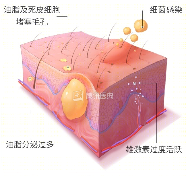 雄激素是刺激油脂分泌的直接原因,而睡眠不足和过度的压力则是两大