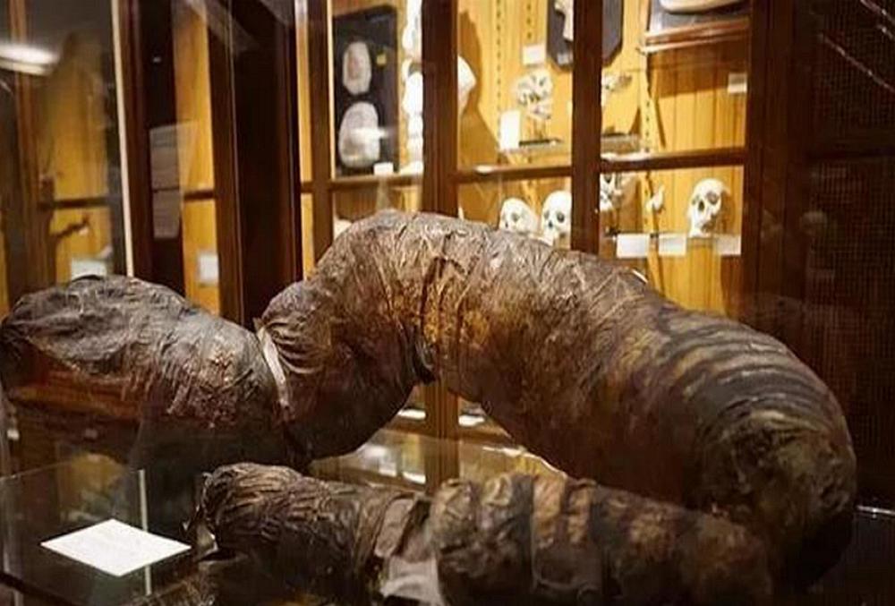 史上第一个被屎憋死的人三年没上厕所肠内粪便重达18公斤