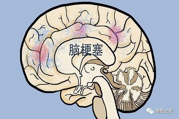 想要老来不中风,三招发现脑梗前兆!