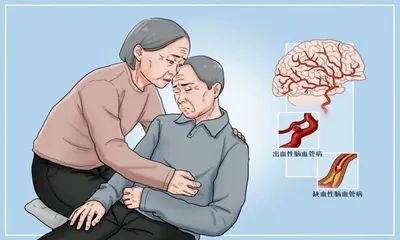 【听出健康】脑中风可咋办 听神经内科专家如何见招拆招