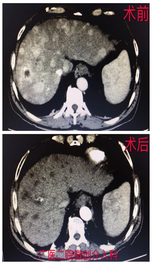 真实案例分享:弥漫性肝癌合并门静脉癌栓,还有方法治疗吗?